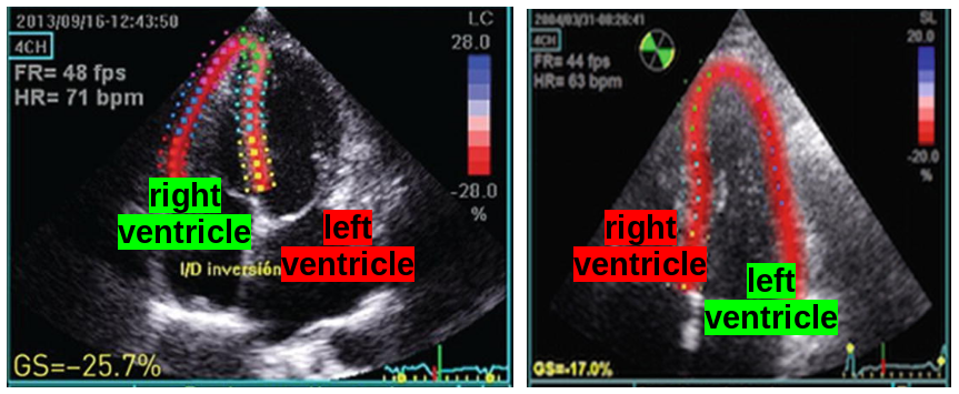 Speckle-tracking on left- or right-ventricular focused echocardiographic sequences. Adapted from  [CIP-19]